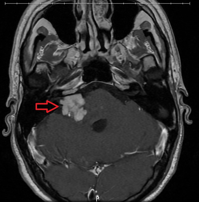 Una imagen médica diagnóstica que muestra una flecha roja señalando una masa blanca en un cerebro.